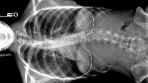 首臺磁性控制骨骼矯正器